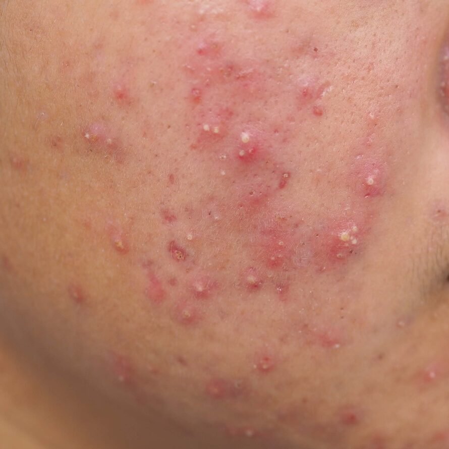 a person with acne on face