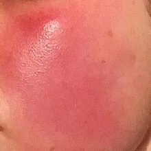 person with red skin who would benefit from rosacea skincare