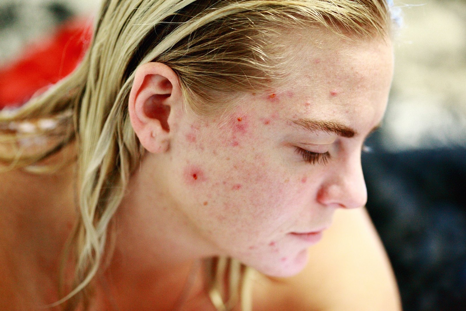 a woman with blonde hair and red spots on her face