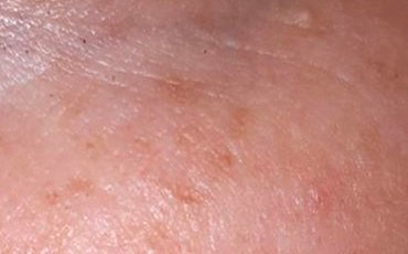 aktinic keratosis after treatment