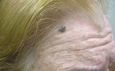 aktinic keratosis before on forehead