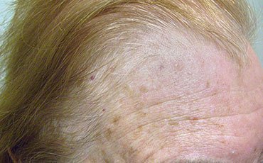 aktinic keratosis on forehead after cryopen treatment