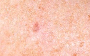 seborrhoiec keratosis after treatment with the cryopen