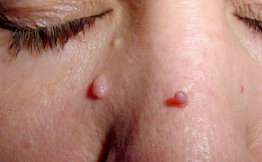 skin tag before treatment