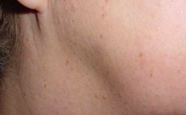 warts removed from the face after treatment