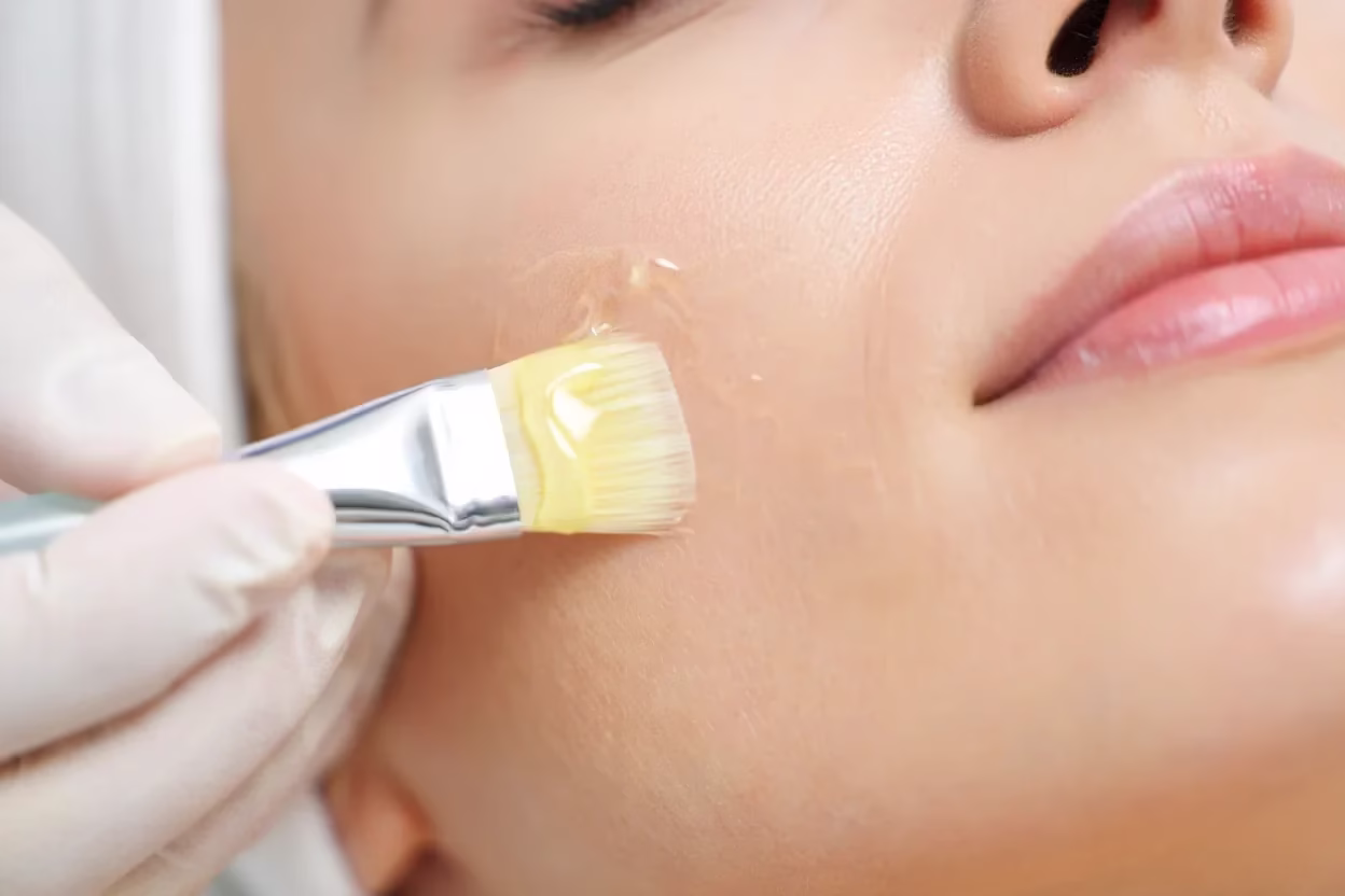 update on chemical peels with a woman having the latest peel applied to her cheeks